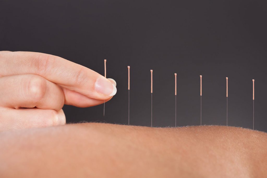 Acupuncturists Near Me! At ARC Acupuncture & Physical Therapy