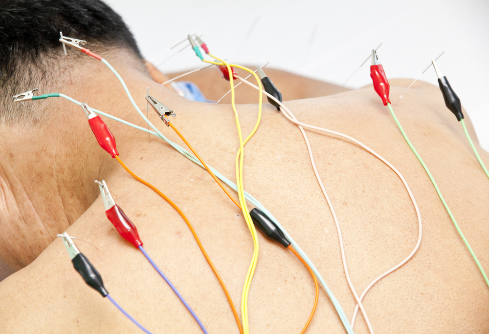 Acupuncture avec stimulation électrique