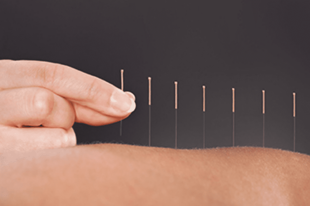 Acupuncture As A Pain Management Tool