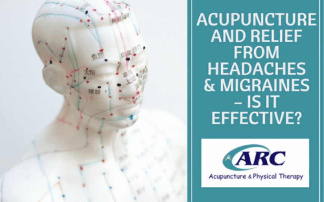 Acupuncture and Relief from Headaches and Migraines – Is It Effective?