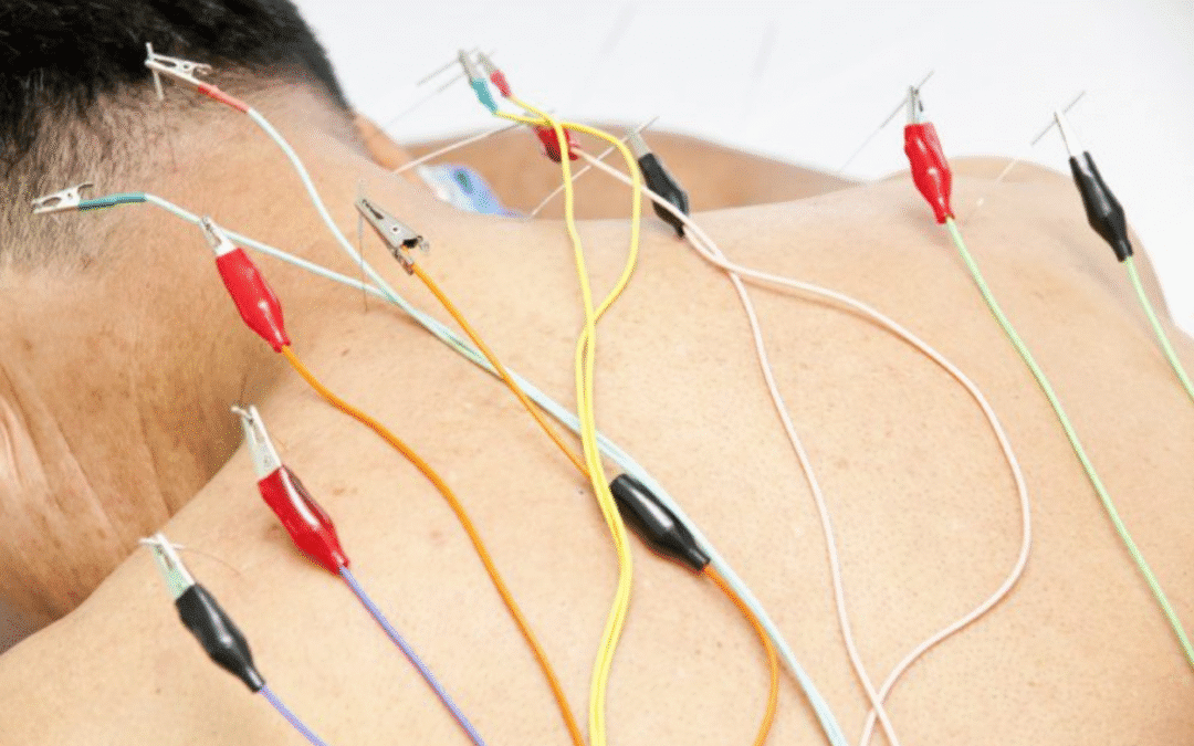 Acupuncture with Electric Stimulation