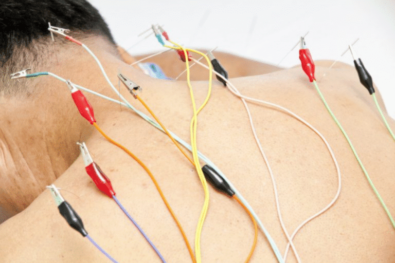 Acupuncture with Electric Stimulation