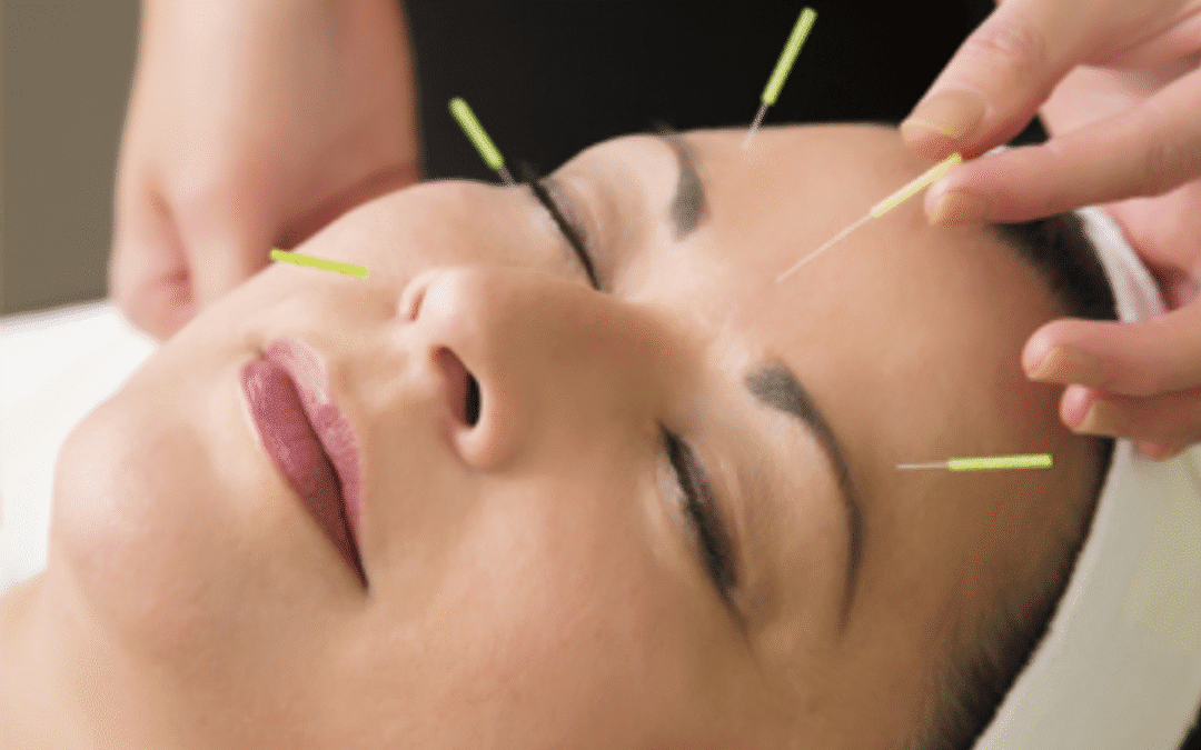 Stress & Anxiety? Acupuncture can help