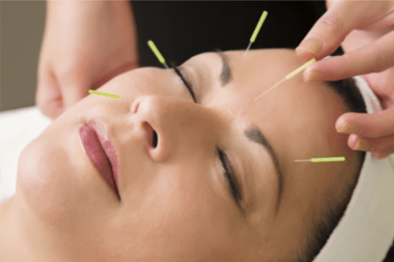 Stress & Anxiety? Acupuncture can help