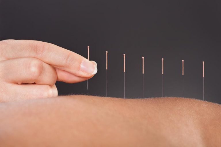 Acupuncturists Near Me! At ARC Acupuncture & Physical Therapy